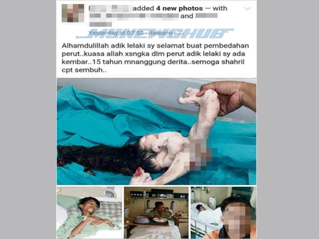 Terkejut Kembar 'Tumpang Hidup' Dalam Perut 15 Tahun