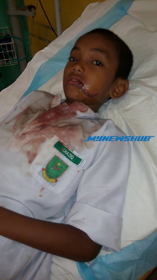 Mulut, Pipi Terkoyak Terkena Tombol Pintu Di Sekolah