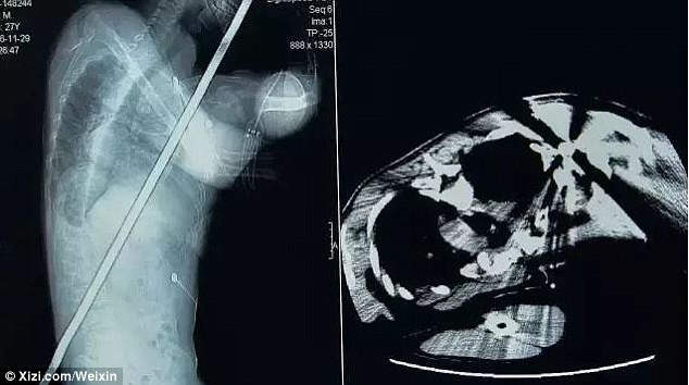 Ngeri.. Batang Besi 6 Kaki Tertusuk Bahu Ke Pinggang