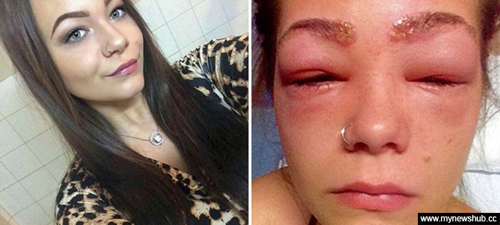 Remaja Nyaris Buta Akibat Pewarna Rambut