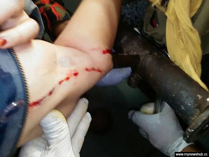 Lengan Wanita Tercucuk Besi Mesin Kisar Kelapa