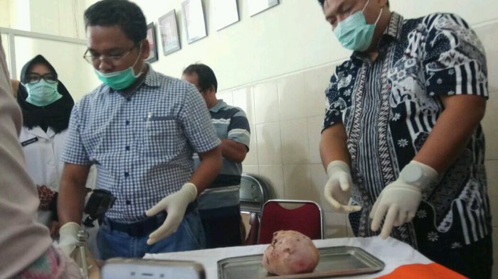 Heboh! Wanita Indonesia Lahirkan Bayi Jadi Batu