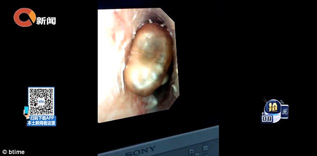 Kacang Tumbuh Dalam Telinga Budak 6 Tahun