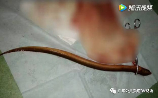 Doktor Keluarkan Belut 50cm Dari Perut Lelaki...