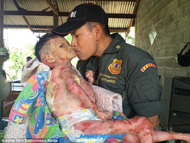 Remaja 16 Tahun Hidap Penyakit Kulit