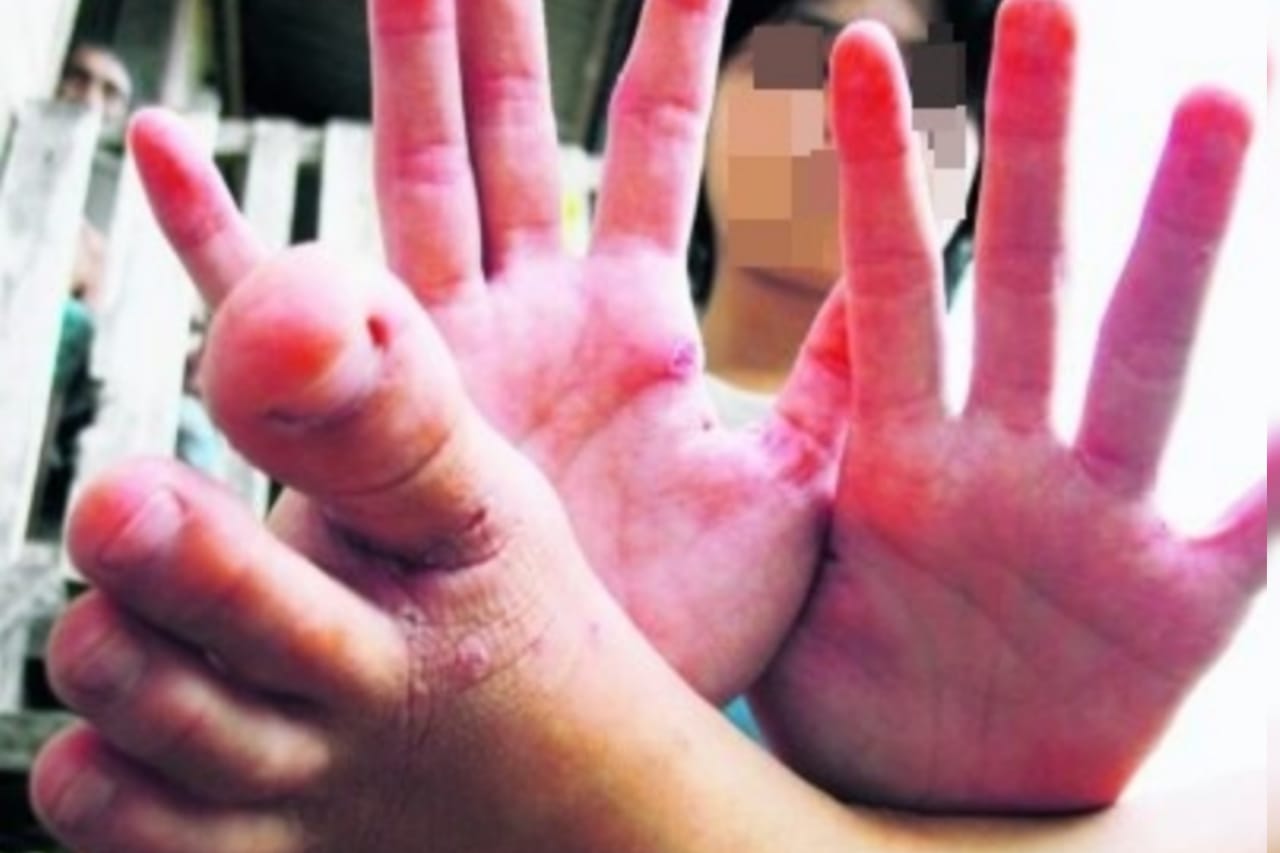 HFMD: Kes Baharu Turun 35.9 Peratus