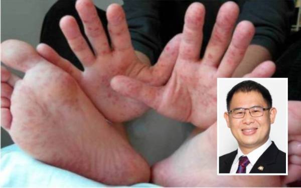 Kes HFMD Di Johor Meningkat 81.6 Kali Ganda