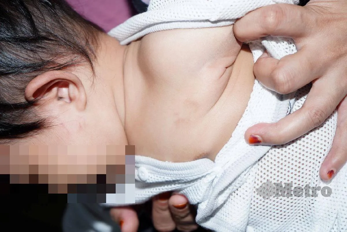 Kesan Gigitan Di Muka Bayi, Pengasuh Ditahan Polis