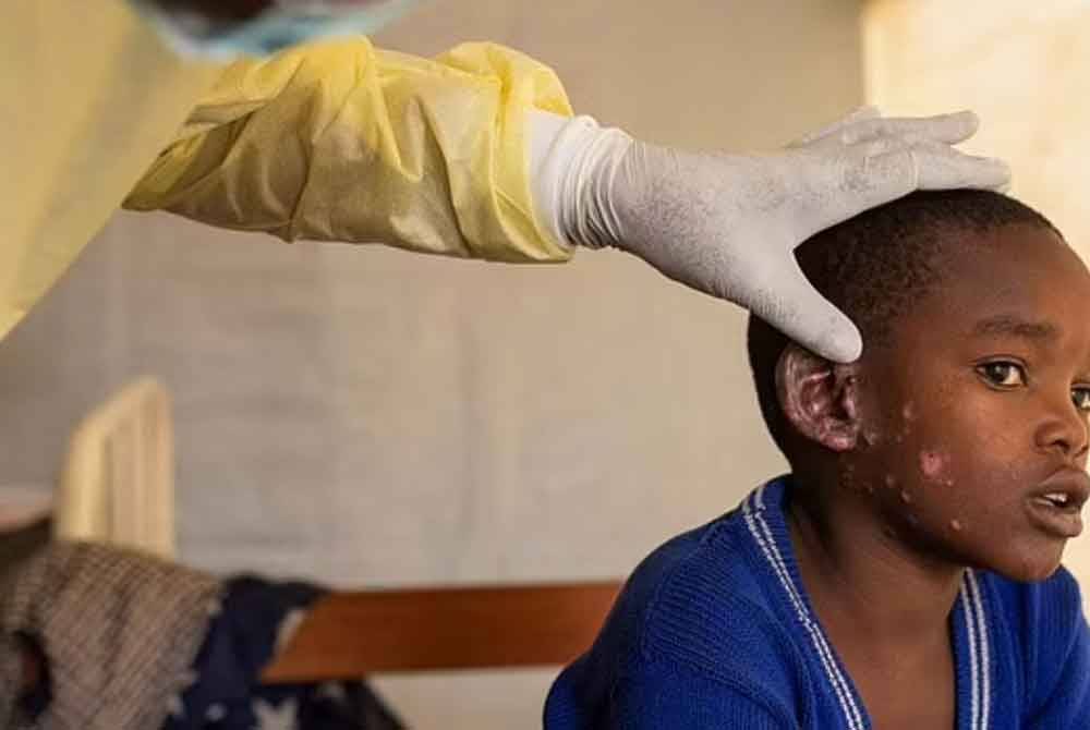 Pakistan, Sweden Lapor Kes Pertama Mpox