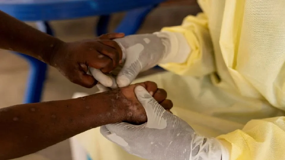 Pejabat Kesihatan Jakarta Lapor 11 Kes Mpox