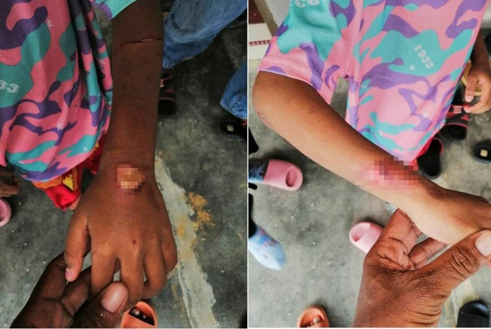 Kanak-kanak 6 Tahun Jadi Mangsa Dera Bapa Kandung, Ibu Tiri